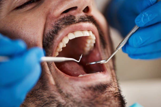 Best Broken or Chipped Tooth Repair in Boulder Creek, CA